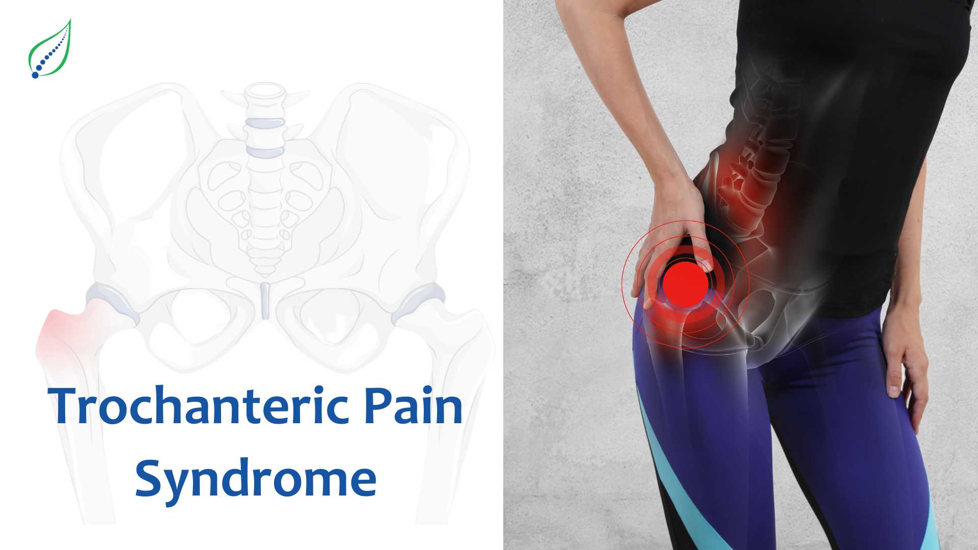 Greater Trochanteric Pain Syndrome: Causes, Symptoms, and Treatment